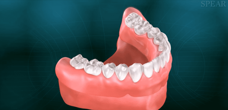 root canal