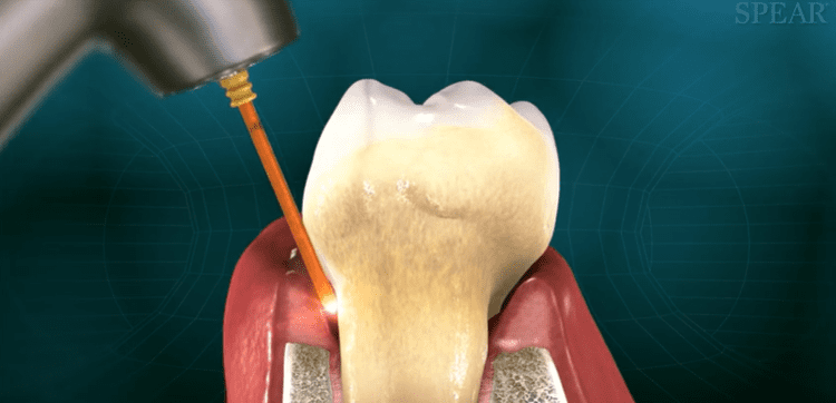 dental implants